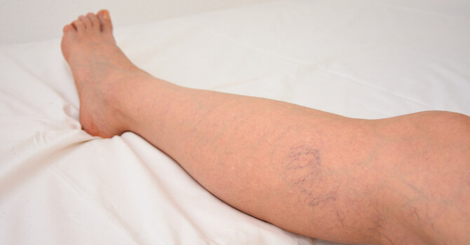 Sclerotherapy