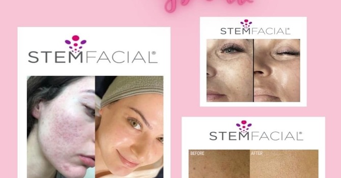 StemFacial Microneedling