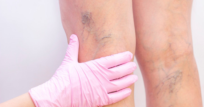 Who Can Benefit from Sclerotherapy?