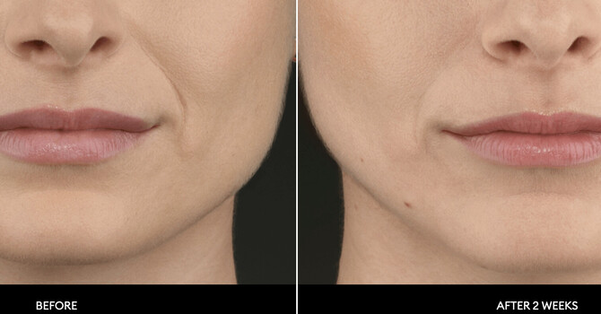 Evolysse Smooth Derma Filler